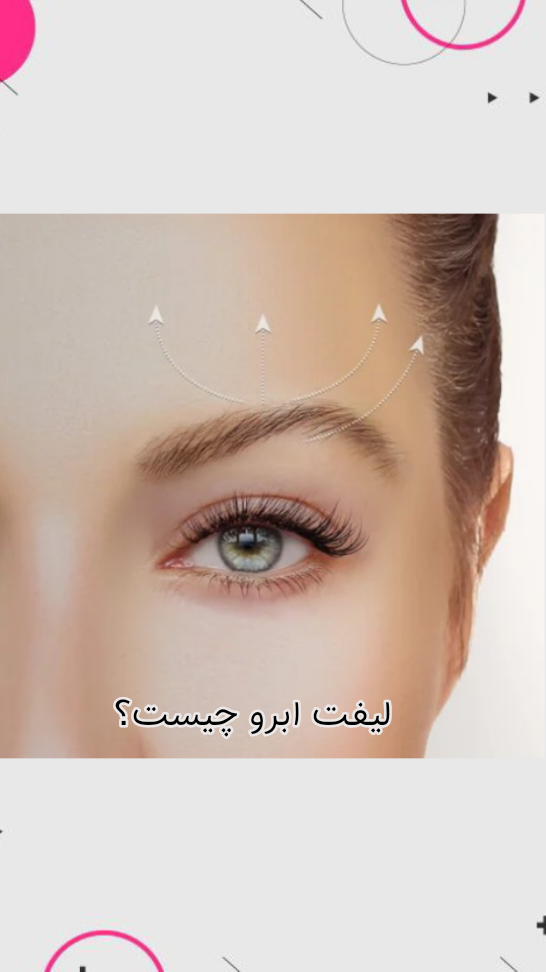 لیفت ابرو چیست؟ روش ها، مزایا و معایب + فیلم